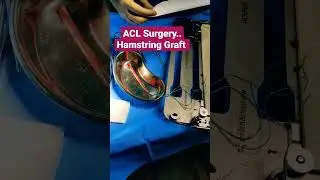 ACL Surgery..Hamstring Graft ..Dr Sai Chandra