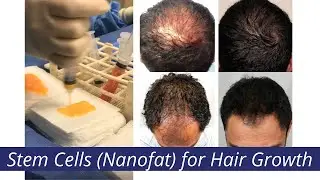 #StemCell Therapy for #HairLoss [How do Stem Cells Work for Hair Regrowth?]