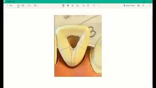 Centering and Opening Up Your ADEX Endo Prep For Pulp Chamber Alignment | ADEX Exam Tips
