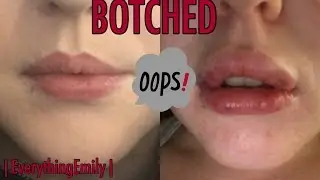 LIP INJECTION FAIL - UNEVEN LIPS?! | EverythingEmily