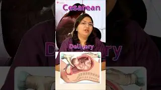 IVF se Pregnant &ndash; Normal Delivery या C-section? #myth #ivf #pregnancy