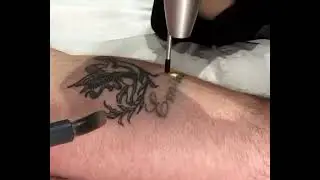 Laser Tattoo Removal in action at Radiant Living, near Wigan