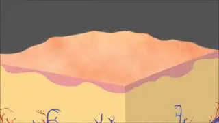 Picosure Focus Laser - Non-Surgial Laser Rejuvenation in Plano and Dallas Texas