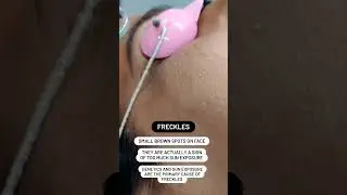 Freckles Treatment | Skin Care Routine | #drvishalchugh #skincare #frecklestreatment #freckles