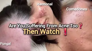 How to  Treat Acne  at Home   |  