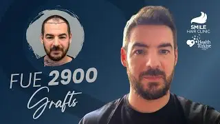 2900 Grafts Hair Transplant: 12-Month Before & After Progress