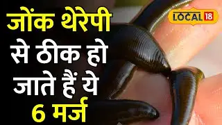 Leech Therapy: इस थेरेपी से बड़ी बड़ी बीमारियां हो जाती है छु मंतर! | #local18
