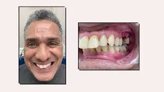 Yomi Robot Dental Implant Patient Testimonial | Ora Dentistry | Dr. Devan Dalla