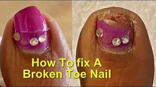BROKEN TOENAIL/ASMR BROKEN TOENAIL TRANSFORMATION AT HOME  EXTENSION/FIXING MY BROKEN TOENAIL