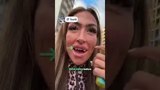 Her turkey teeth only lasted a few days!!!! #teeth  #turkey  #veneers  #dentist