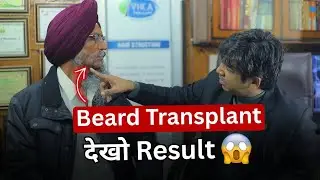 Scared of Beard Transplant?Watch This 65-Year-Old Patients Experience|Beard Transplant Success Story