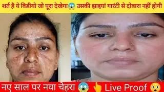 Bomb क्रीम😱झाइयों पर सीधा वार करेगी क्रीम😱नई पुरानी कैसी भी झाइयां दावा है चली जाएगी Live Proof 100%