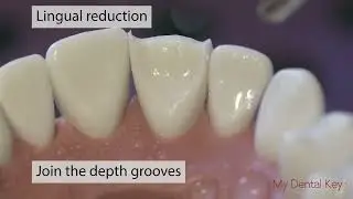 PASS THE CDCA   All Ceramic Anterior Crown Preparation   My Dental Key