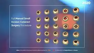 HelpMeSee: Cataract Surgery High Fidelity Simulator