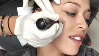 THE VAMPIRE FACIAL