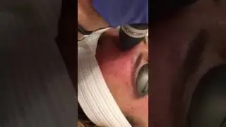 Fractionated Erbium Treatment: The Skin Care Treatment for you!
