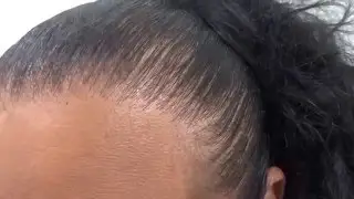 Hairline Feminization by Neopel