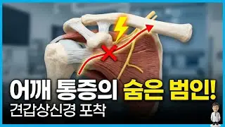 Chronic shoulder pain that won't go away: Could the problem be the suprascapular nerve?