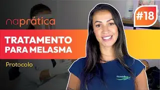 naprática #18 | Protocolo de Microagulhamento para tratamento de melasma | Rentalmed