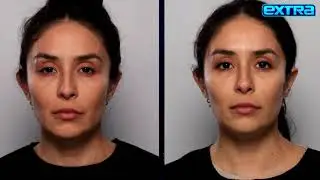 Fight Sagging and Wrinkles with Skin-Tightening Sofwave Treatment