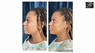 Dermal Fillers Special - Flawless Faces