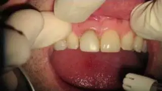 Esthetic Gingival Recontouring with a Picasso Laser
