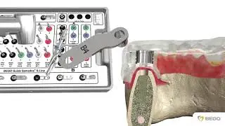 Guided Surgery with BEGO Guide S-Line