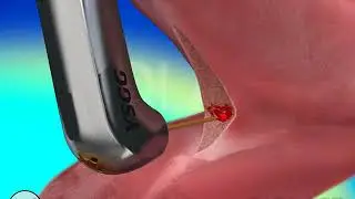 How tongue tie laser works