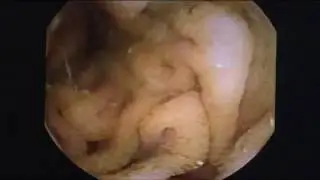 Diverticulosis vs Diverticulitis