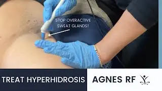Stop Overactive Sweat Glands with Agnes RF