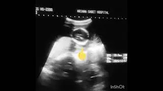 ABRUPTIO PLACENTA  Subchorionic/marginal; collection of blood in subamniotic space