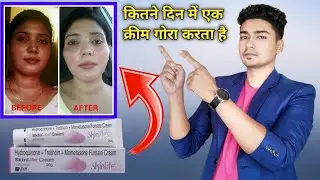 Skinlite cream review | एक क्रीम से चेहरा गोरा करने पर क्या साइड इफेक्ट होता है