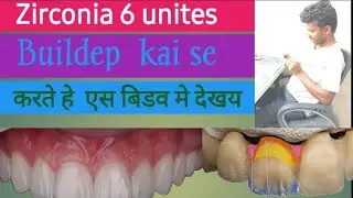 Zirconia liyaring kai  se karte hai aur enamal kai se lagate hai is video dekhia#shortvideo #dental 