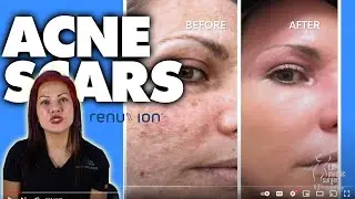 Renuvion J-PLASMA For ACNE Scars - See The Results...