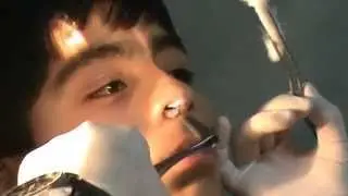 MANEJO PRACTICO EPISTAXIS VIDEO.wmv