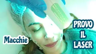 MACCHIE SUL VISO (MELASMA)? PROVO IL LASER DYE