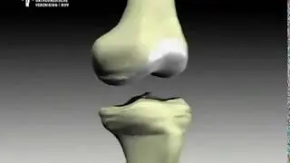 Animatie behandeling artrose