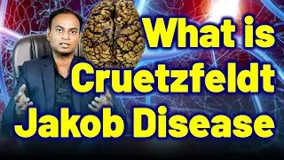 What is Creutzfeldt Jakob Disease , Prions Disease , MadCowDisease -ChronicWastingDisease ?