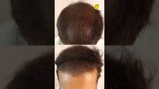 😱 GFC Hair Treatment RESULTS in Just 6 Months! 💇&zwj;♂️✨ | Real Transformation 🏆🔥