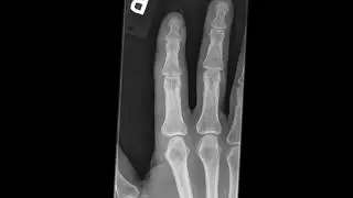 Volar Plate Avulsion
