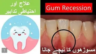 Stop Gum Recession| Causes& Treatment| Sensitive teeth |गम मंदी को रोकें 