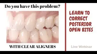 Posterior open bite webinar - Orthodontic Matters Episode 12