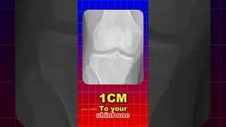 Microfracture method to grow taller. #height#longerlegs