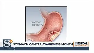 Doctors advise patients on living healthy during Stomach Cancer Awareness Month