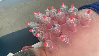 Shoulder Treatment (Rotator Cuff) | Soft Tissue Release (STR)