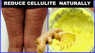 MY AT HOME CELLULITE TREATMENTS | CELLULITE HOME REMEDIES | Khichi Beauty