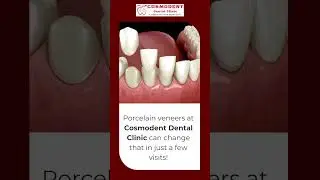 Porcelain Veneers at Cosmodent Dental Clinic | Get a Flawless Smile Makeover Today!