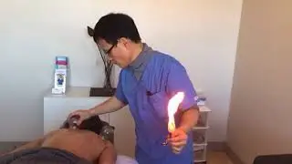 Fire Cupping Demonstration