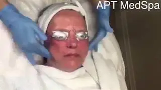 Clinical Peel at APT Medical Aesthetics