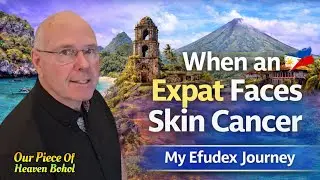🩺 My Efudex Journey: What 28 Days of Skin Cancer Treatment Really Looks Like 🌞